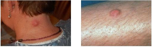 Sebaceous Cyst